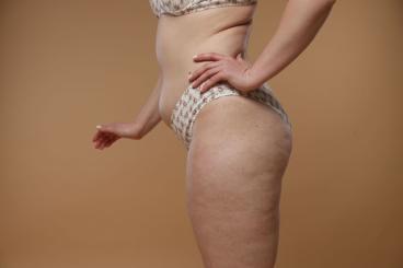 Fenomén "Skinny Fat": Prečo si štíhla, ale máš celulitídu? | Schudni s DaVe