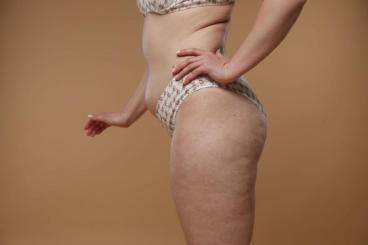 Fenomén "Skinny Fat": Proč jsi štíhlá, ale máš celulitidu? | Schudni s DaVe